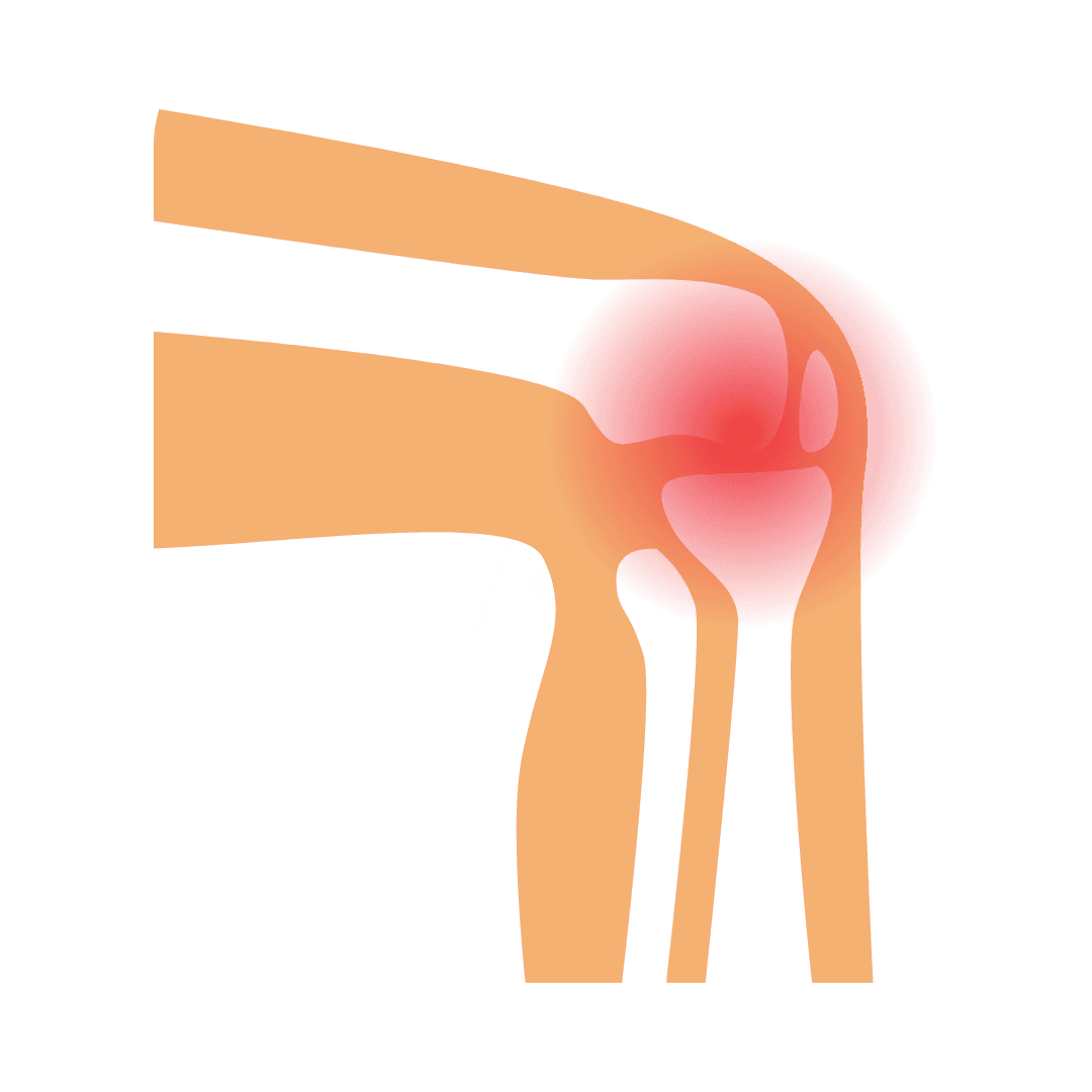 Arthritis