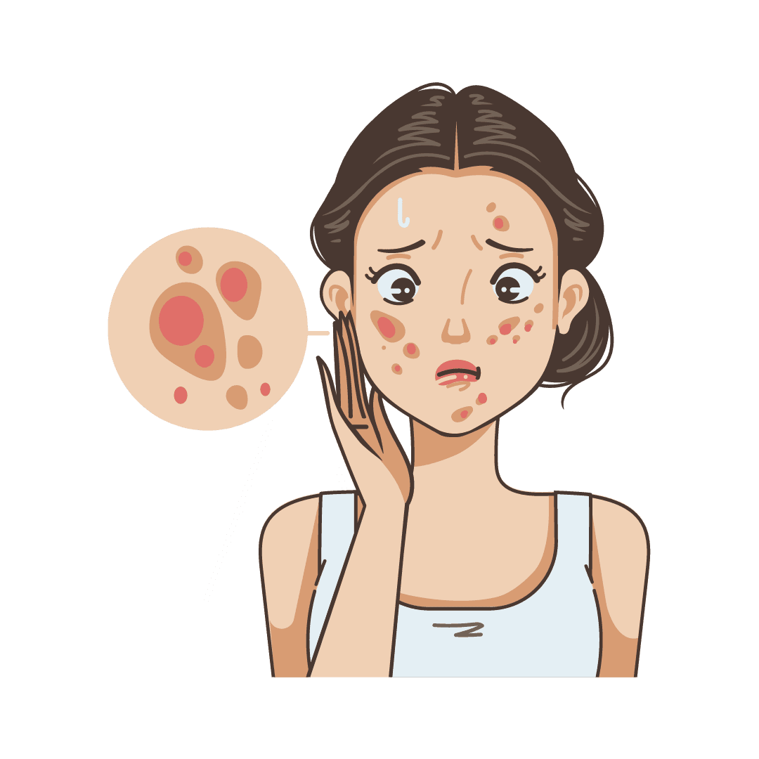 Acne and acne