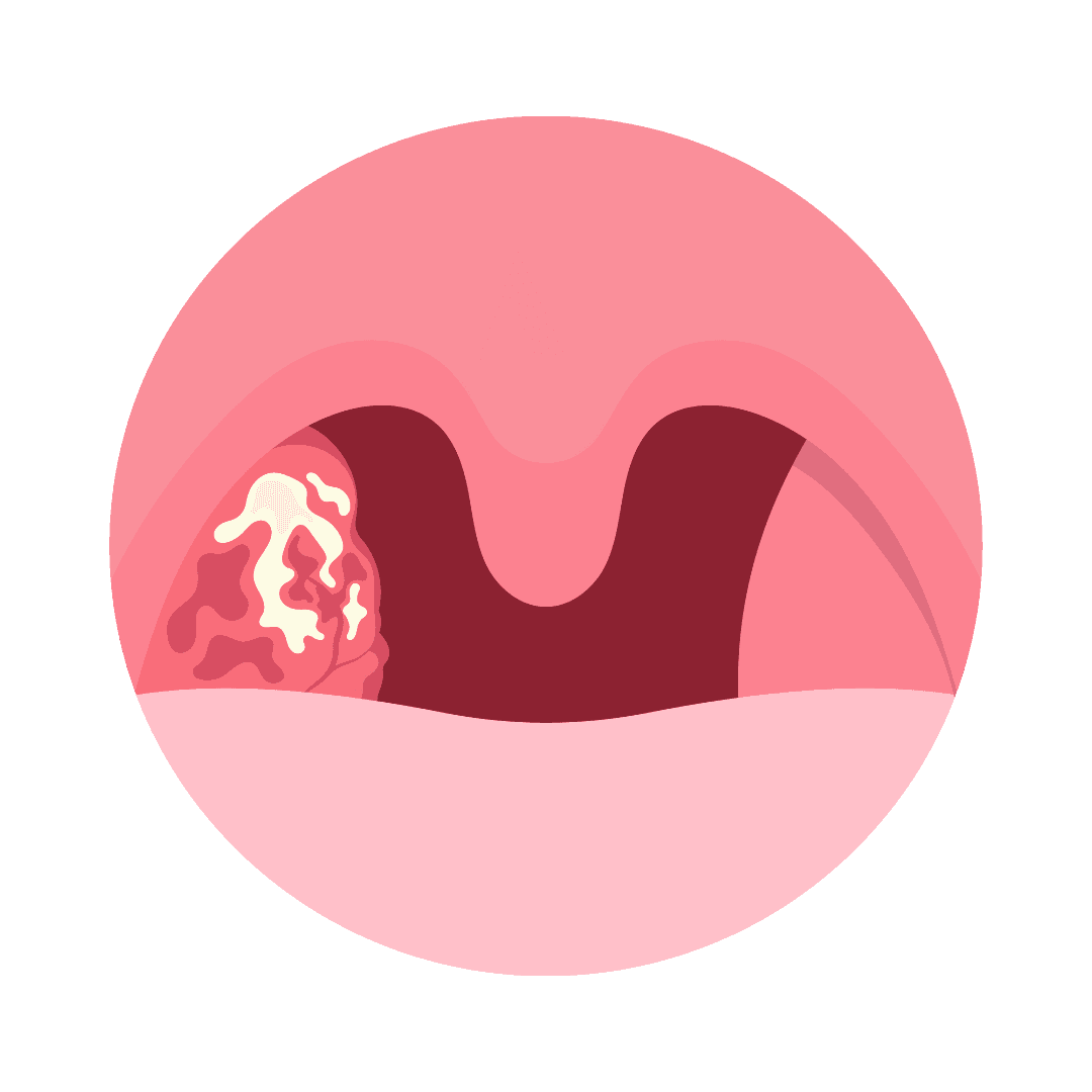 Adenoids