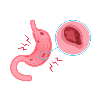 Gastric and duodenal ulcer